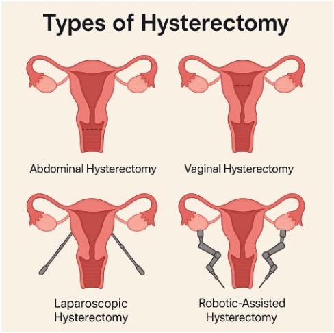 Types of Hysterectomy and Their Costs