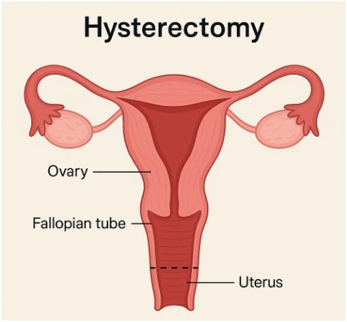 How Much Does a Hysterectomy Cost with Blue Cross Blue Shield?