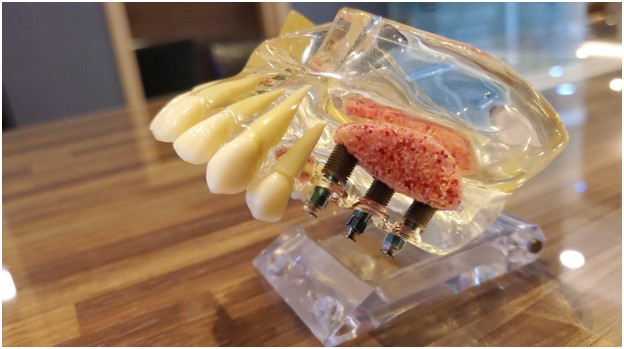 How Much Do Nuvia Dental Implants Cost?