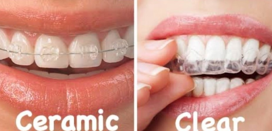 Are Metal Braces the Cheapest Option