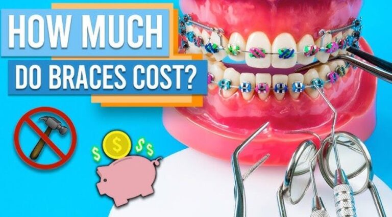 How Much Do Braces Cost? Here’s What You Need to Know Before You Commit