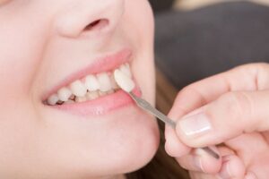 How Much Do Veneers Cost