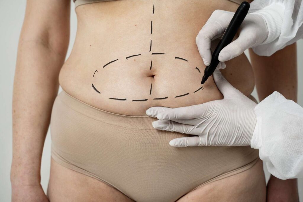 What Factors Can Affect the Cost of a Tummy Tuck