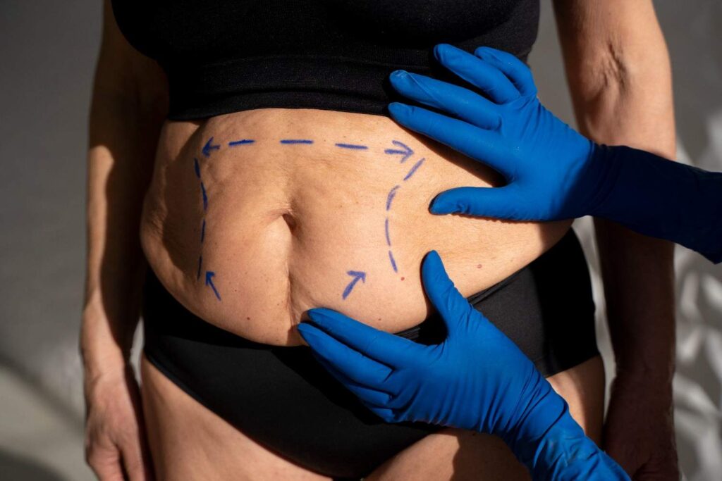 What Is a Tummy Tuck, and Why Is It So Pricey