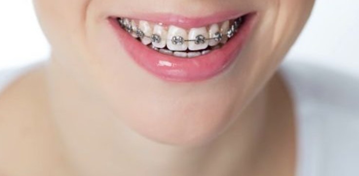 What’s the Real Price Tag on Braces