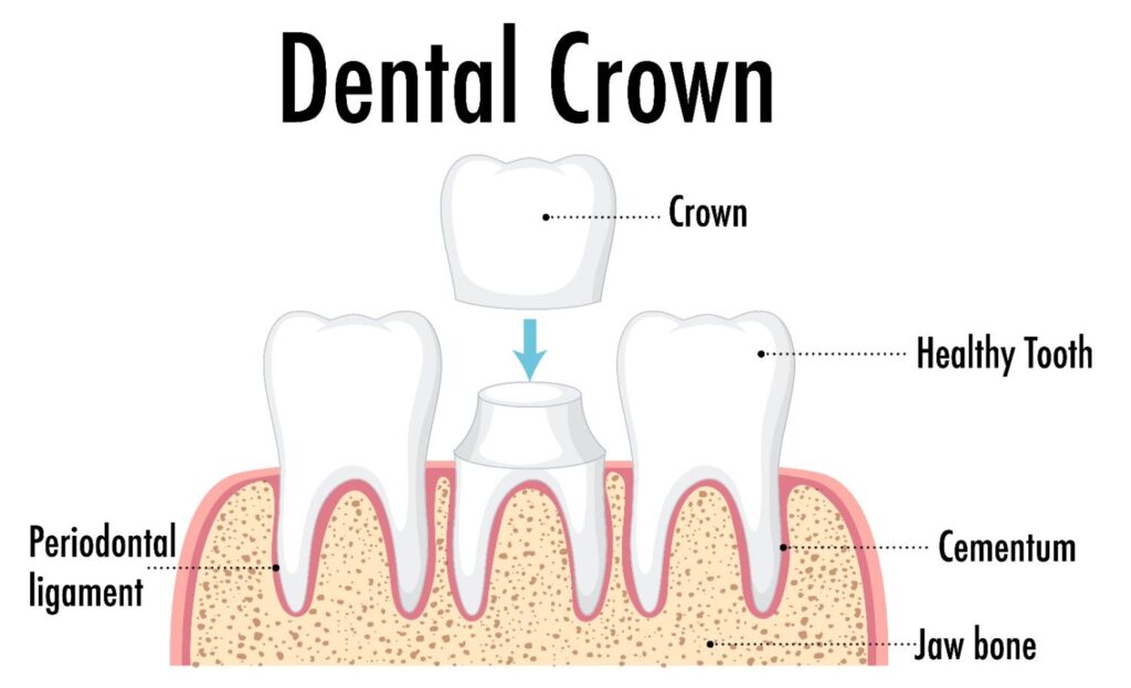 What Kinds of Crowns Can You Get 